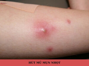 hút mủ mụn nhọt