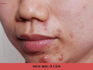 mụn bọc ở cằm