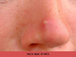 mụn bọc ở mũi