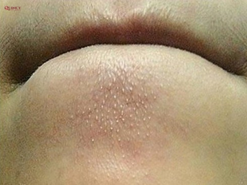 Cách khắc phục mụn cám tại nhà bạn nên biết 6 mụn cám
