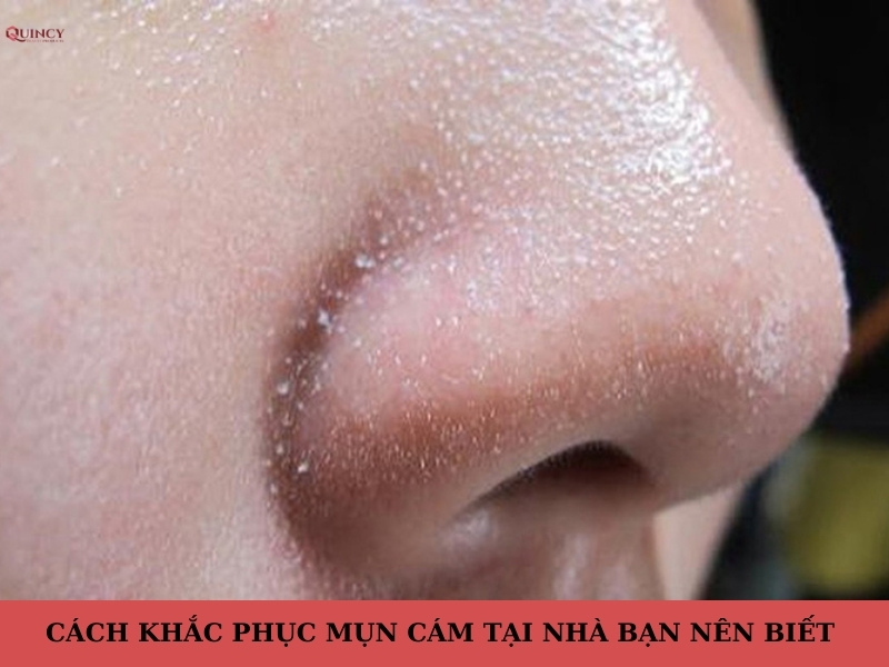 mụn cám