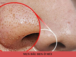 mụn đầu đen ở mũi
