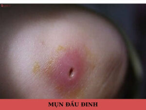 mụn đầu đinh