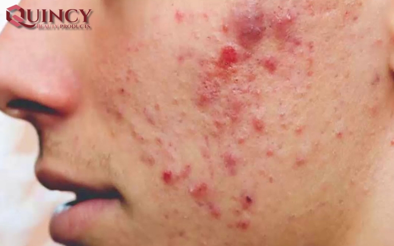 Triệu chứng của Mụn Đầu Đỏ Nodules là gì?