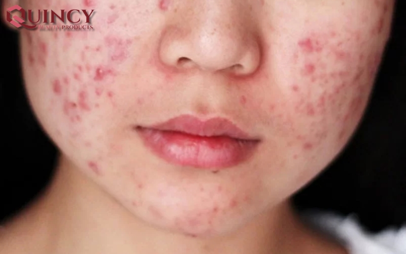 Nguyên nhân gây ra Mụn Đầu Đỏ Nodules là gì?
