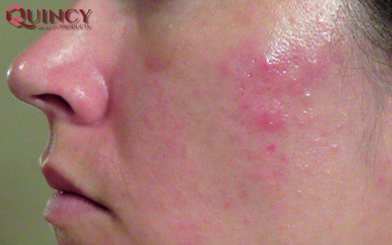 Mụn Đầu Đỏ Nodules là gì? Triệu chứng, Nguyên nhân, Cách điều trị 17 Cách điều trị Mụn Đầu Đỏ Nodules là gì?