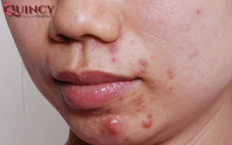 Cách điều trị Mụn Đầu Đỏ Nodules là gì?