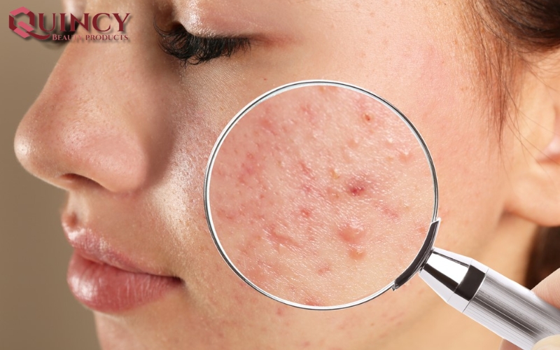 Nguyên nhân gây ra Mụn Đầu Đỏ Nodules là gì?
