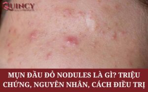 Mụn Đầu Đỏ Nodules là gì? Triệu chứng, Nguyên nhân, Cách điều trị
