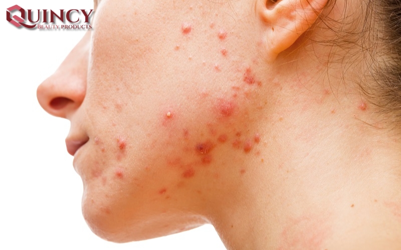 Mụn Đầu Đỏ Nodules là gì? Triệu chứng, Nguyên nhân, Cách điều trị 10 Các vấn đề chung của Mụn Đầu Đỏ Nodules là gì trong da