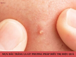 Mụn đầu trắng