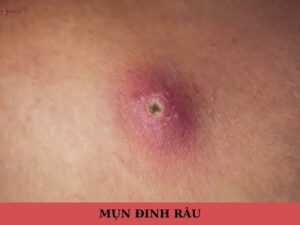 mụn đinh râu