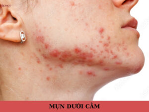 mụn dưới cằm