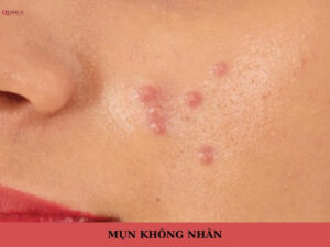 mụn không nhân