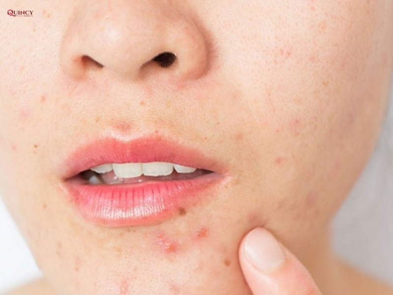 Mọc mụn ở cằm: Biểu hiện, nguyên nhân và phương pháp điều trị 6 mọc mụn ở cằm