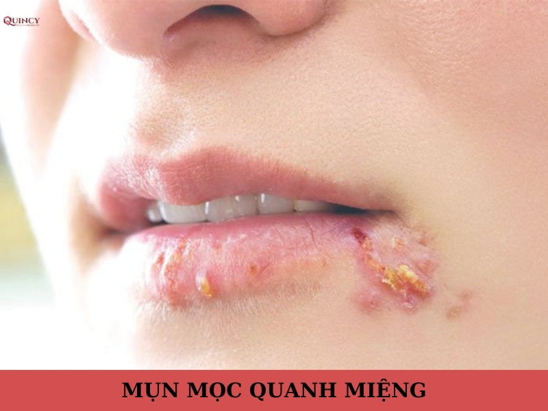 mụn mọc quanh miệng
