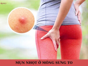 mụn nhọt ở mông sưng to
