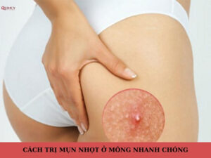 Mụn nhọt ở mông