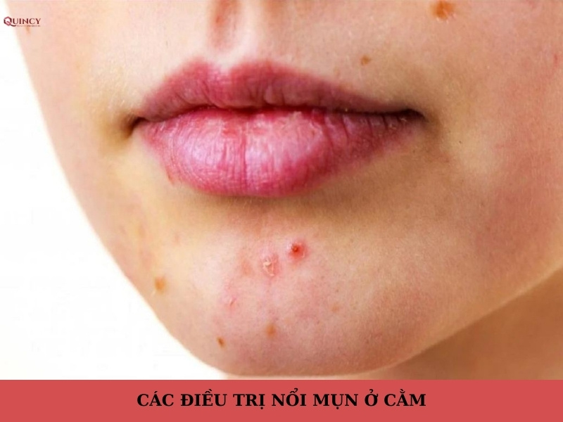 Mụn ở cằm