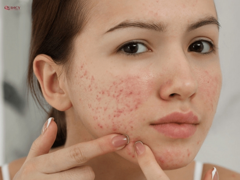 Mụn ở má: Nguyên nhân và cách điều trị hiệu quả 6 mụn ở má
