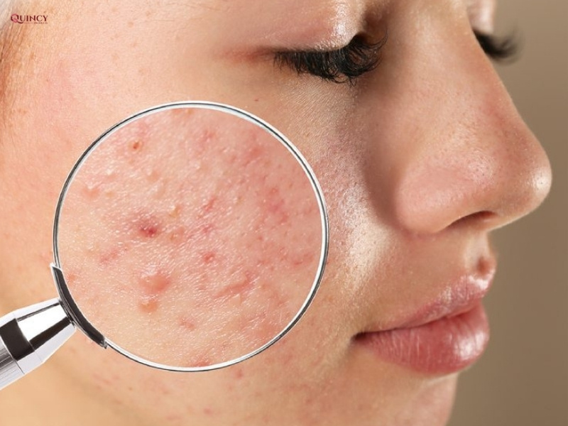 Mụn ở má: Nguyên nhân và cách điều trị hiệu quả 7 mụn ở má