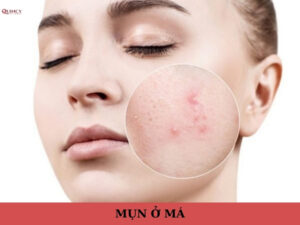 mụn ở má
