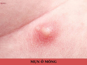 mụn ở mông