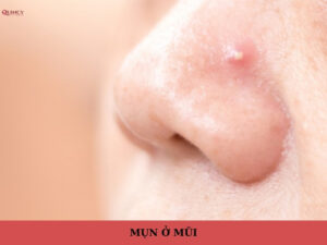 mụn ở mũi