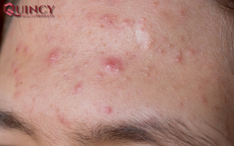 Mụn sưng Cysts là gì? Hiểu rõ Vấn đề - Cách Đối phó chi tiết 21 Kết Luận Mụn sưng Cysts là gì?