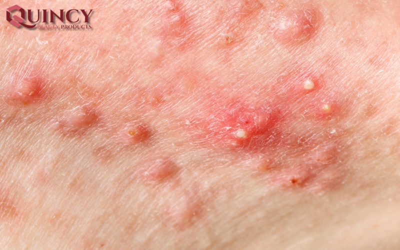 Cách Đối phó và Điều trị Mụn sưng Cysts là gì?