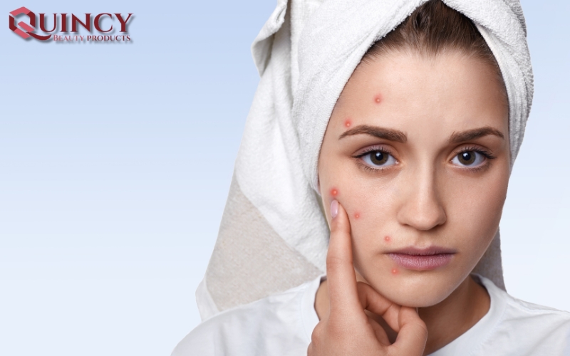 Cách Đối phó và Điều trị Mụn sưng Cysts là gì?