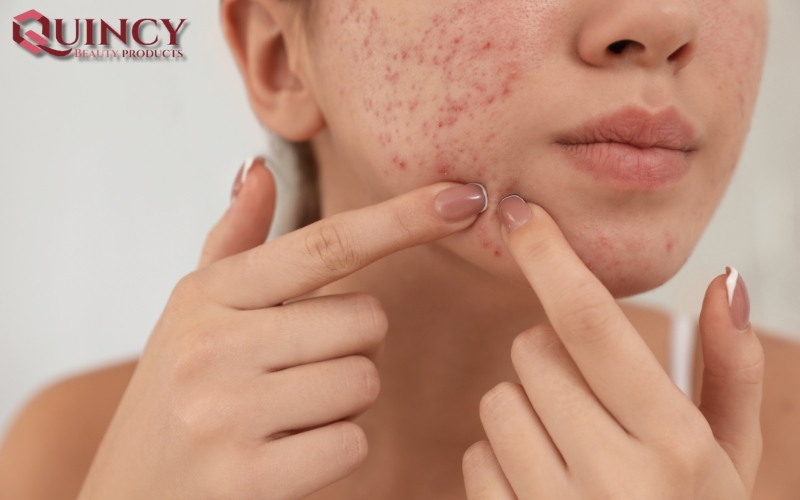 Nguyên nhân gây ra Mụn sưng Cysts là gì?