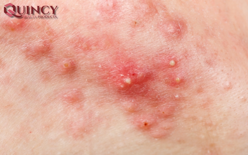 Nguyên nhân gây ra Mụn sưng Cysts là gì?
