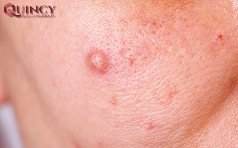 Triệu chứng và Đặc điểm của Mụn sưng Cysts là gì?