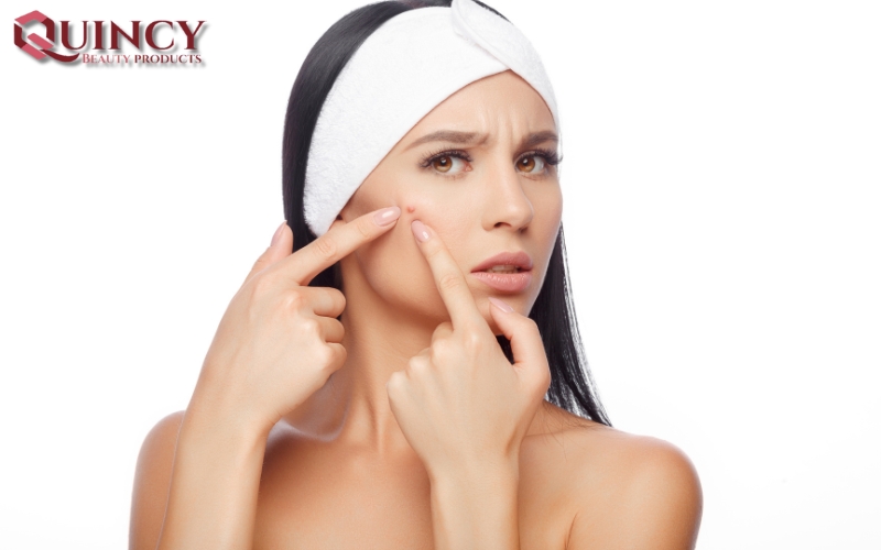 Triệu chứng và Đặc điểm của Mụn sưng Cysts là gì?