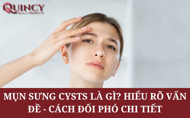Mụn sưng Cysts là gì? Hiểu rõ Vấn đề - Cách Đối phó chi tiết