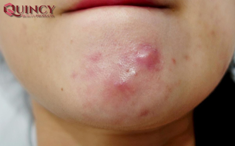 Mụn sưng Cysts là gì? Hiểu rõ Vấn đề - Cách Đối phó chi tiết 12 Tầm quan trọng của việc hiểu rõ về Mụn sưng Cysts là gì và cách đối phó với chúng