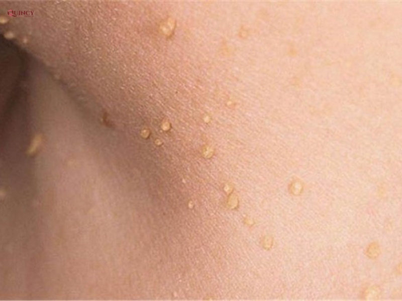 Mụn thịt ở cổ có lây không? 7 mụn thịt ở cổ