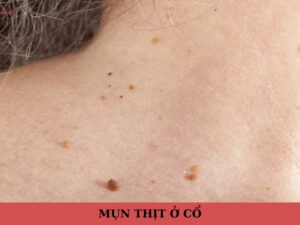 mụn thịt ở cổ