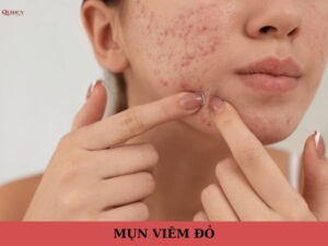 mụn viêm đỏ