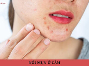 nổi mụn ở cằm