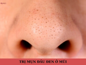 trị mụn đầu đen ở mũi