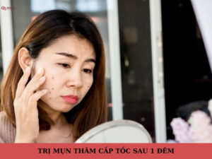 trị mụn thâm cấp tốc