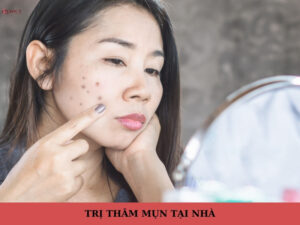 trị thâm mụn tại nhà