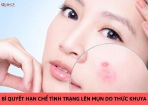 bí quyết hạn chế tình trạng lên mụn