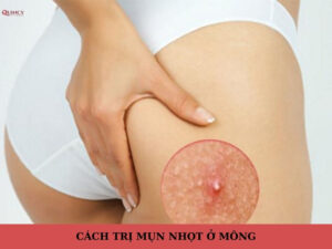 cách trị mụn nhọt ở mông