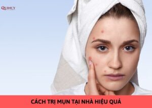 cách trị mụn tại nhà hiệu quả