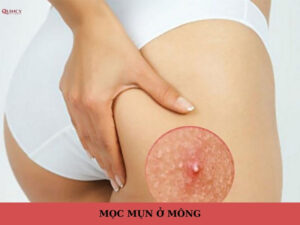 mọc mụn ở mông