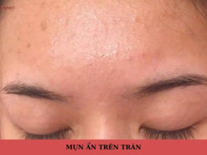 mụn ẩn trên trán
