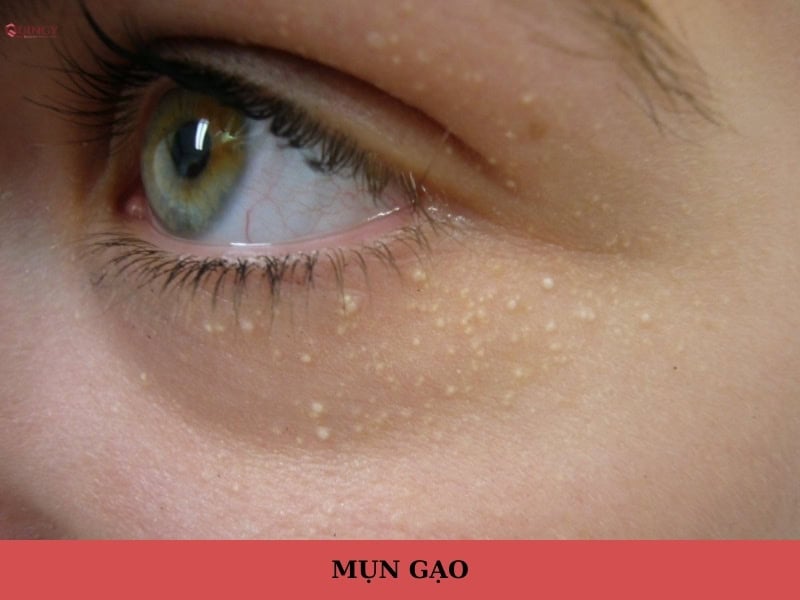 mụn gạo